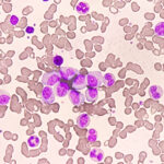 Bexobrutideg Produces Rapid and Durable Responses in CLL