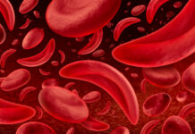 Institution Describes Challenges after Release of Commercial Formulation of Hydroxyurea