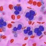 Study: Obinutuzumab Safe and Effective in Relapsed or Refractory Follicular Lymphoma