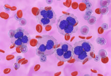 Study: Obinutuzumab Safe and Effective in Relapsed or Refractory Follicular Lymphoma